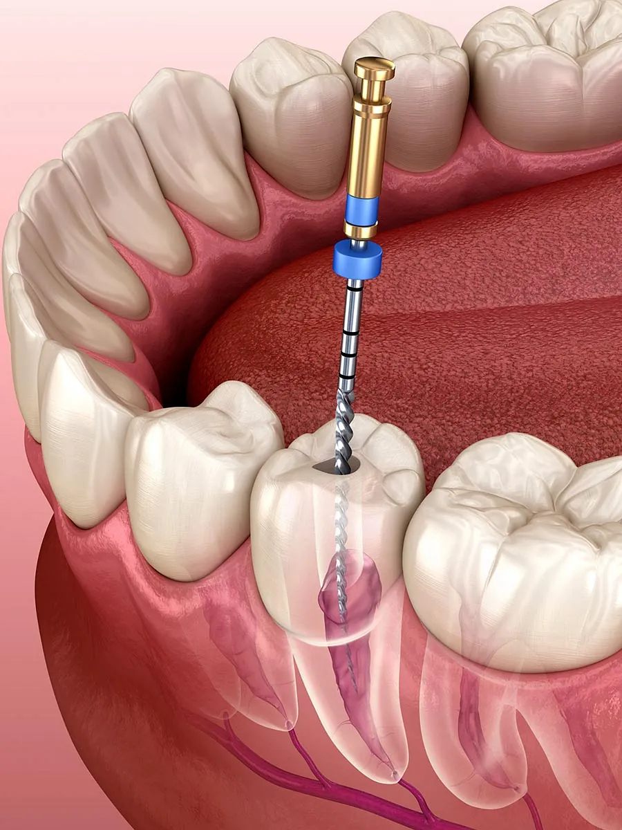 Tratamiento de endodoncia